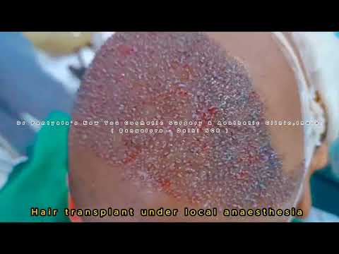 Hair Transplant in Bangalore India | Top hair...