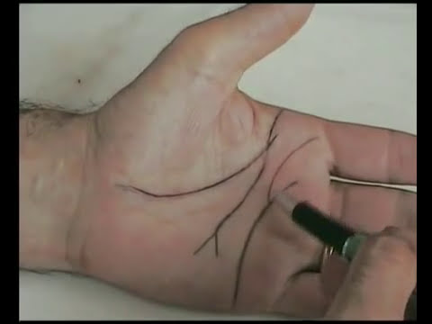 Dolore dal collo alla lama sul lato destro e dà in mano Tintura di iodio di aglio per giunti