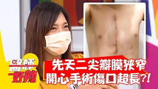 先天二尖瓣膜狹窄，「開心手術」傷口超長？！【#醫師好辣】20210901 part1 EP1193 吳東諺 袁明琦