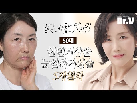 [日 / Eng SUB] 50대 안면거상술+눈썹하거상술 5개월차 후기를 공개합니다! _ #切開リフト