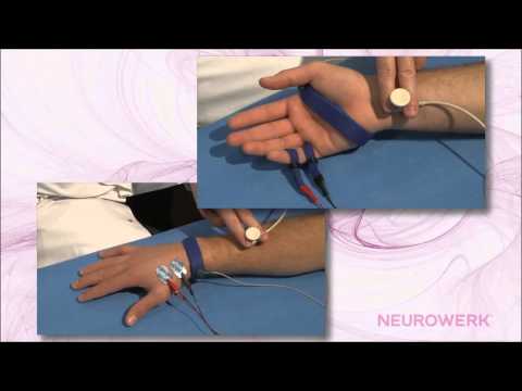 Sensory Neurography - Median Nerve