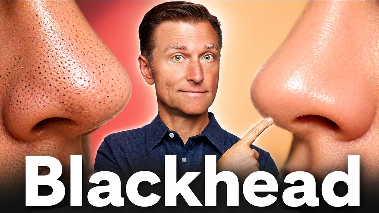 The #1 Remedy for Blackheads That Actually Works