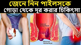 জেনে নিন পাইলসকে গোড়া থেকে দূর করার চিকিৎসা Piles Treatment in Bangla