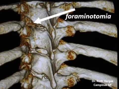 Mal di schiena per oltre una settimana Alleviare il dolore in osteocondrosi della colonna vertebrale toracica video