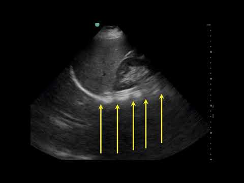 Pleural Effusion Ultrasound
