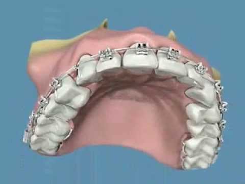 Artiglio del diavolo per le articolazioni Dolore al collo dopo trauma cranico