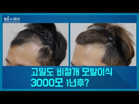모발이식 고밀도 비절개 3000모 1년경과 Man hair transplantation (FUE) result after 12month 1500 grafts (뉴헤어)