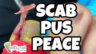 TOE SMASHED, SCAB PEELED OFF THEN PUS SEEPS FROM THE INGROWN TOENAIL!