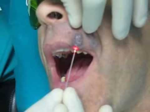 Trattamento di ernia intervertebrale in ospedale Pirogov Glutei dolore e la gamba