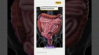 Download lagu Kesulitan Buang Air Besar (Konstipasi) mp3