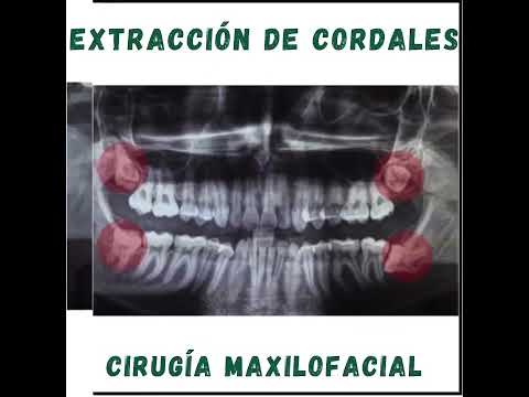 Extracción de cordales - Cirugía de cordales en Barranquilla