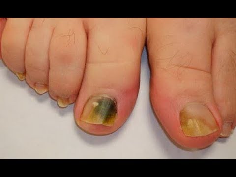 Comme Traiter Le Microorganisme Végétal Des Ongles Sur Les