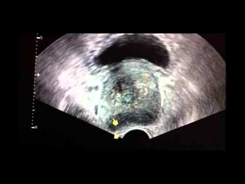 Come ridurre il dolore della prostata Trattamento esperienza personale di prostatite