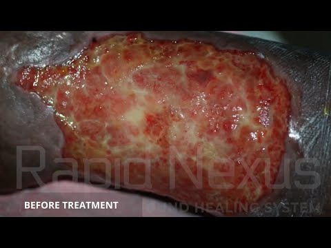 Patient FS Before-After Video