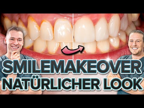 Smile Makeover - 8 Veneers in der Front / Frontzahnveneer Patientenfall