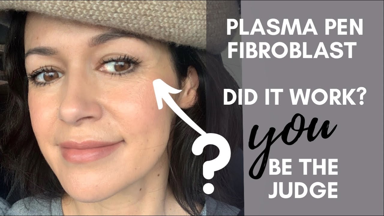 Fibroblast Plasma Pen - Does It Work YOU decide. My 3 Month Before & After Pics & Videos