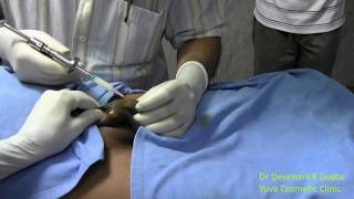 Peyronie's disease Intralesional steroid under penile block