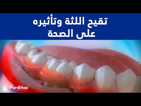 تقيح (اللثة) وتأثيره على الصحة ©