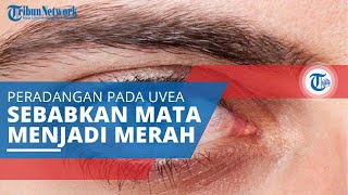 Uveitis, Peradangan pada Uvea atau Lapisan Tengah Mata Ditandai Satu atau Kedua Mata Terlihat Merah