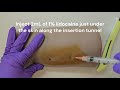 Nexplanon Insertion And Removal Training For OBGYN QUEENS