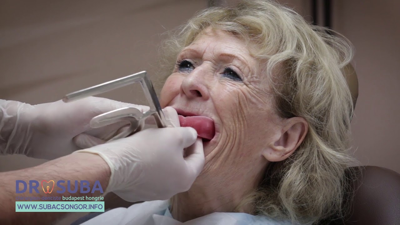 PROTHÈSE SUR IMPLANT Version clipsée amovible Dentiste et prothésiste