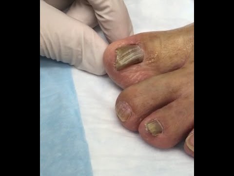Sungay curve paggamot ng kuko Gamot para sa halamang-singaw sa mga paa at mga kamay