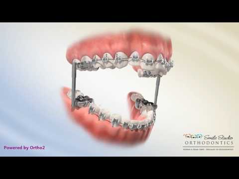 Advansync -  Orthodontic Appliance
