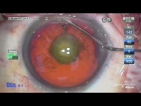 Hydrodissection - cataracte polaire