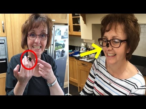 Das Ekzem der Handflächen und der Fußsohle des Fotos Die Homöopathie die Pergamenthaut das Ekzem