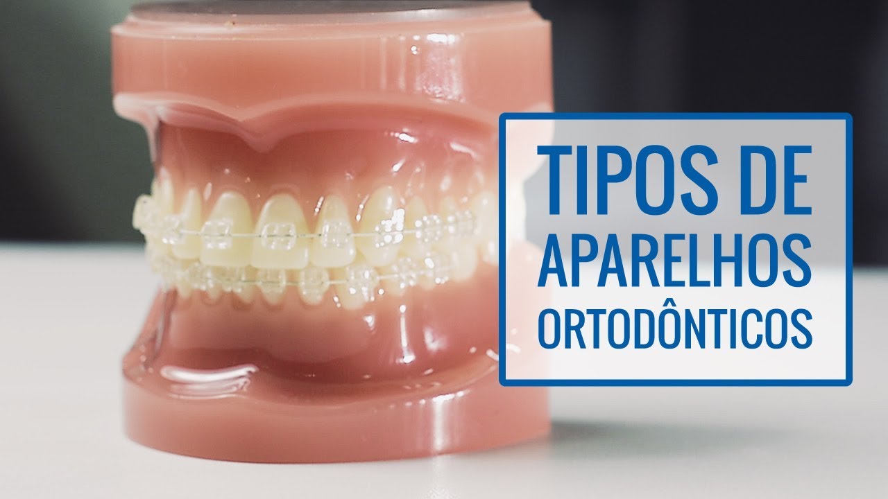 Tipos de Aparelhos Ortodônticos