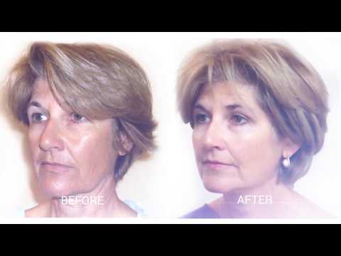 A Non-Surgical Facelift Alternative - Surgeon Minute