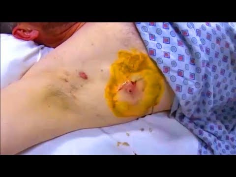 Sino ang nagpagaling sa isang halamang-singaw katutubong remedyong Paggamot pagsasapin-sapin kuko