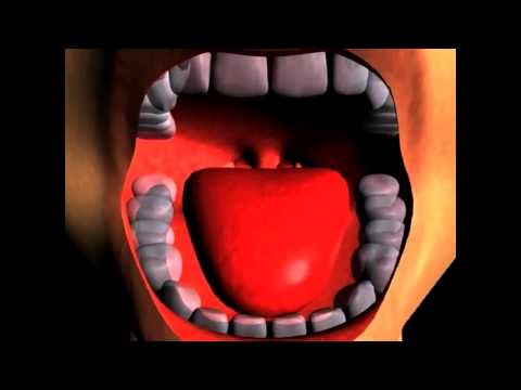 Coblation Soft Palate Treatment