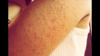 How to Get Rid of Bumps on Arms