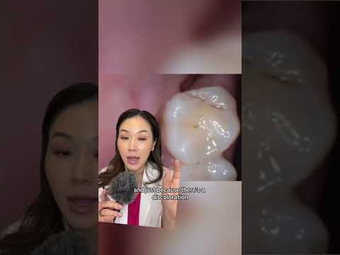 How to tell if you have a cavity. #cavity #cavities #dentist #selfexam