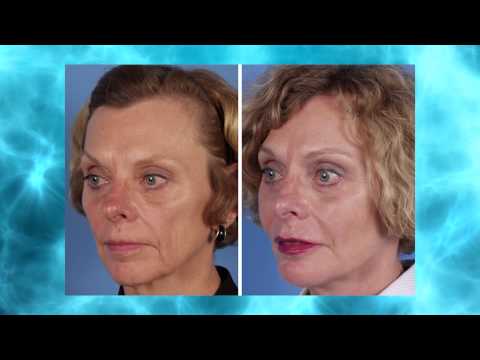 Dr. J. David Holcomb presents a patient education seminar on facelift options