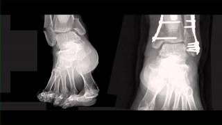 SNAPPED ANKLES // NOWHERE