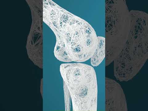 ¿Pérdida de hueso? Esta es la posible causa.