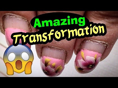 Nail Treatments sa Kazan Paggamot ng fungal impeksiyon ng kuko species