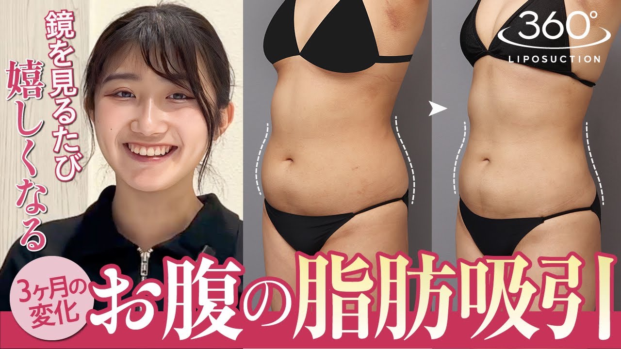 【体験レポート】お腹と腰の360°脂肪吸引|くびれ完成までのダウンタイム記録