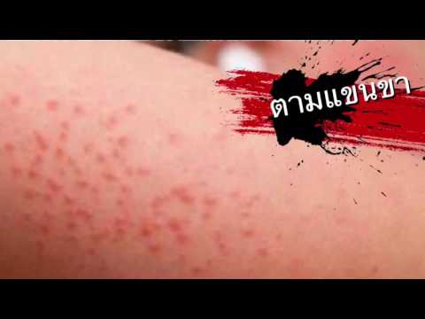 ไฮโดรเจนซัลไฟด์ในโรคสะเก็ดเงิน ซึ่งโรคผิวหนังแพทย์ภูมิแพ้