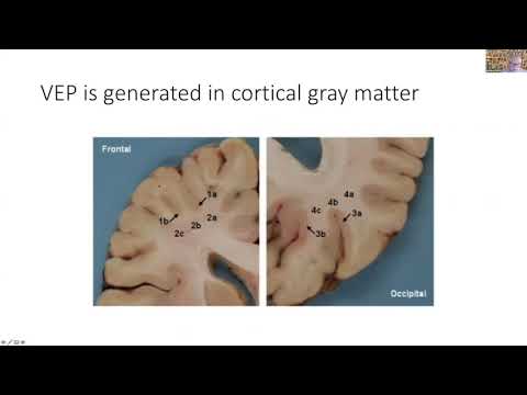 Multi electrode visual evoked potential measurements