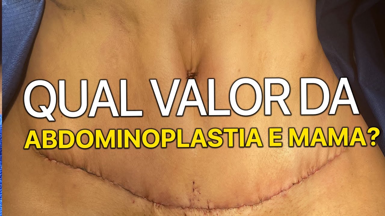 QUAL VALOR ABDOMINOPLASTIA E PRÓTESE DE SILICONE - CIRURGIA PLÁSTICA