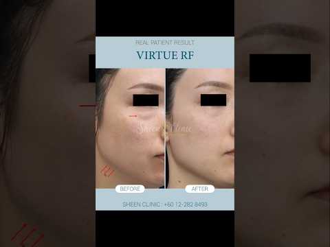 Eye Bags Making You Look Tired? Virtue RF Result