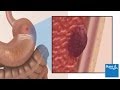 How a peptic ulcer develops