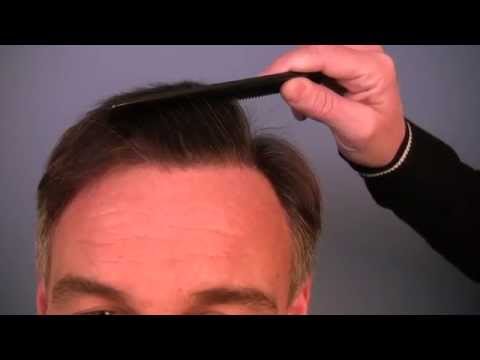 Best Hair Transplant Minnesota - Dr. Paul Shapiro