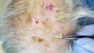 Debulking Lesions on the Scalp (Erosive Pustulosis of the Scalp)  | CONTOUR DERMATOLOGY