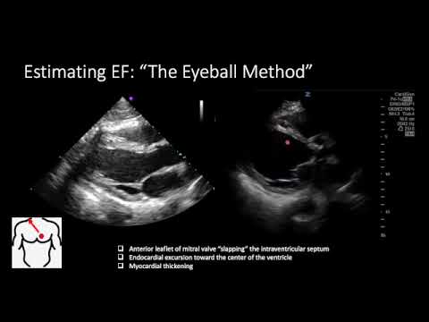 Assessing LVEF with POCUS | Quick, Reliable Bedside Cardiac Function