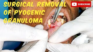 Pyogenic Granuloma/Oral Pregnancy Tumor- Excisional Biopsy #viralvideo #biopsy #pyogenicgranuoma