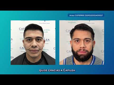 TESTIMONIO INJERTO DE BARBA / CAPILEA MEXICO